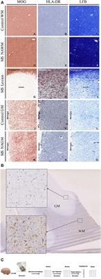 Brain Citrullination Patterns and T Cell Reactivity of Cerebrospinal Fluid-Derived CD4+ T Cells in Multiple Sclerosis